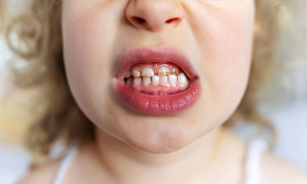Patina batterica sui denti: come prevenirla e rimuoverla.