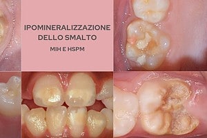 foto ipomineralizzazione denti mih