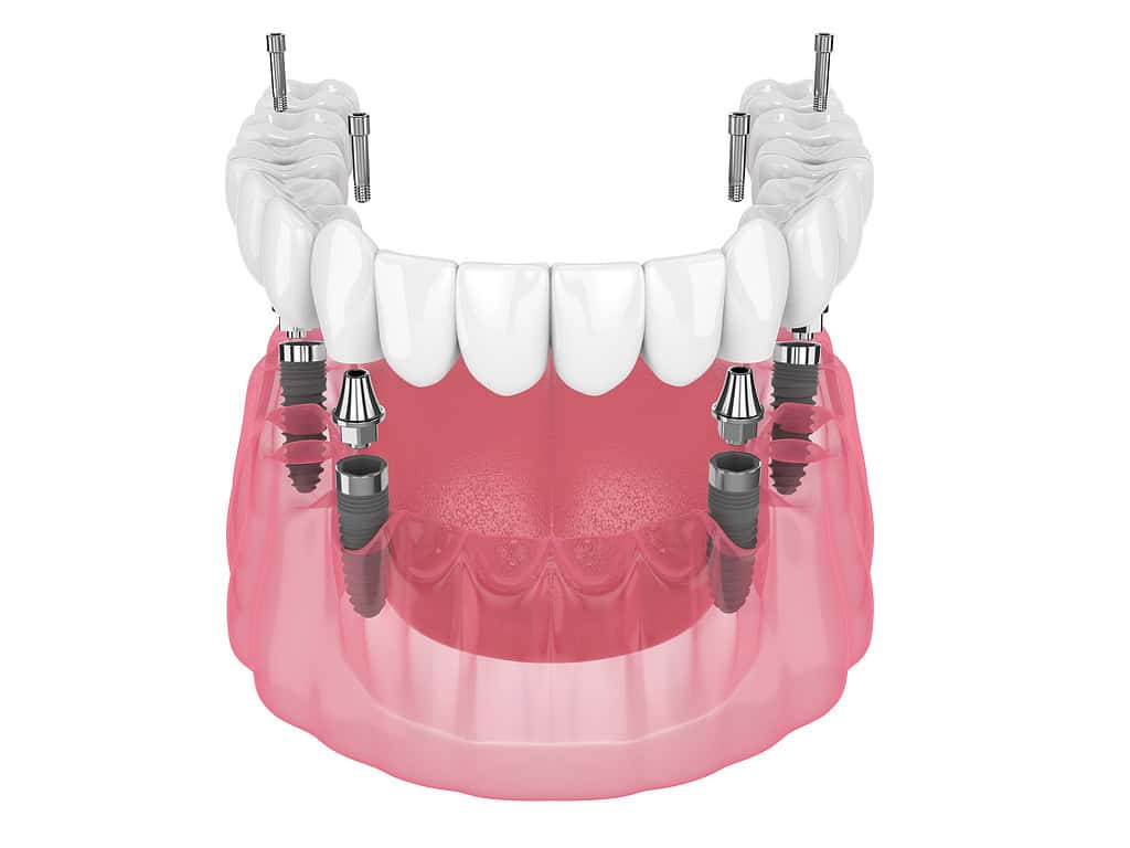 Il Metodo All-on-Four e All-on-Six: la Soluzione per un Sorriso Stabile e Funzionale 3 impianti dentali con protesi avvitata sopra definitiva