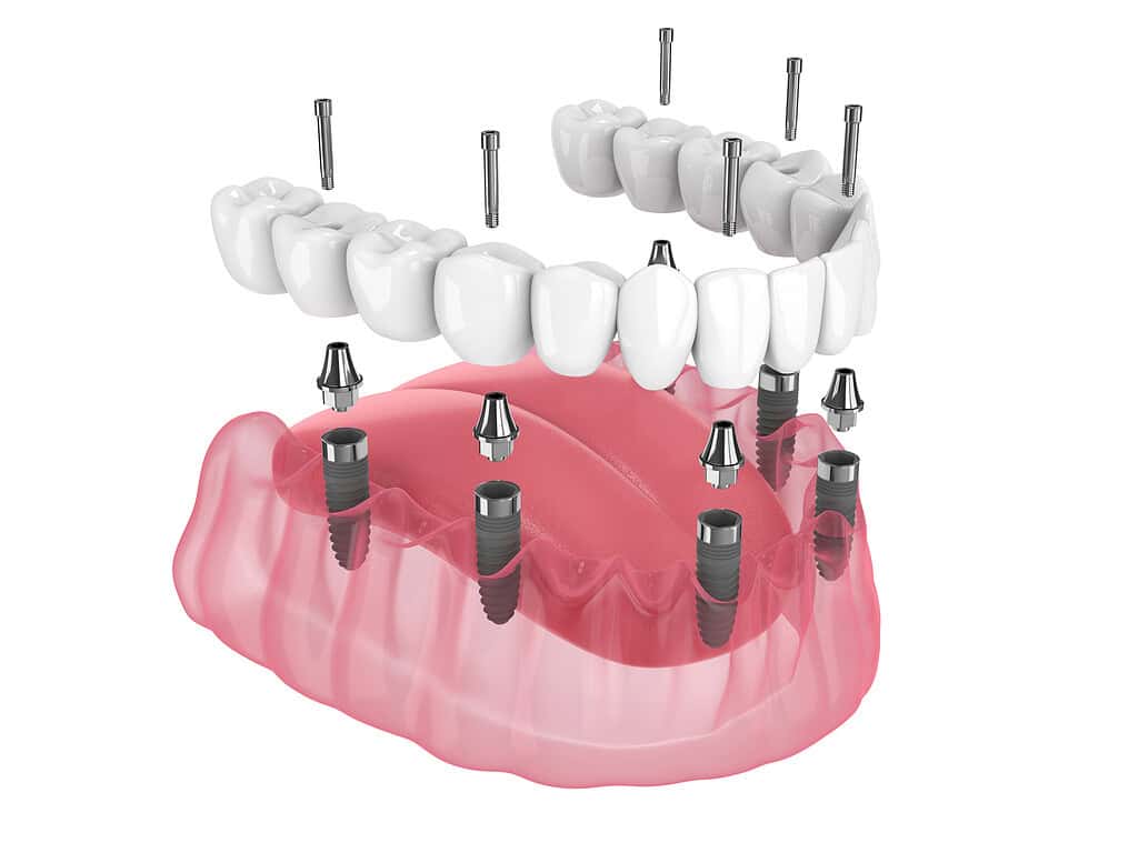 Il Metodo All-on-Four e All-on-Six: la Soluzione per un Sorriso Stabile e Funzionale 2 arcata dentale con impianti con dentatura fissa avvitata
