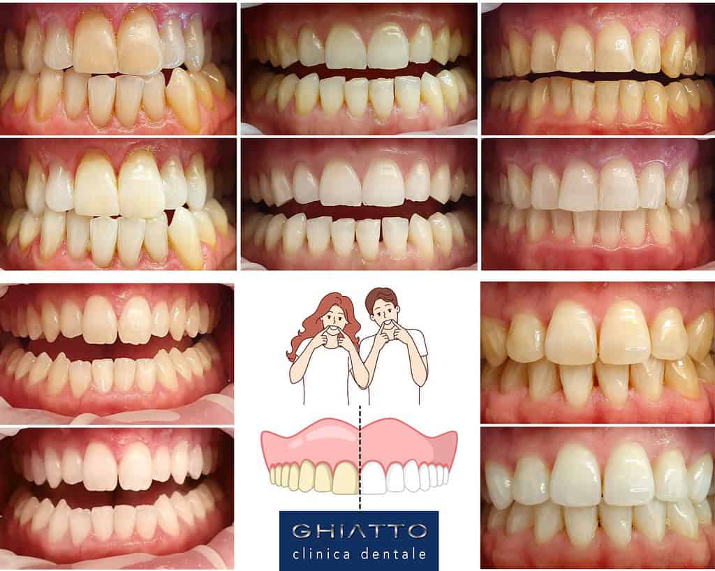 Sbiancamento dentale: prevenzione, miti e trattamenti 2 immagine prima e dopo di denti sbiancati con diversi tipi di sbiancamento