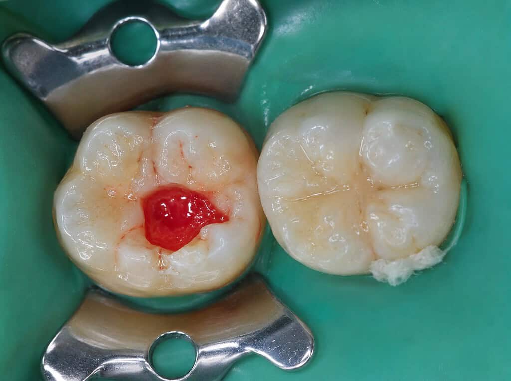 Pulpite estiva nei bambini 2 Dente con pulpite
