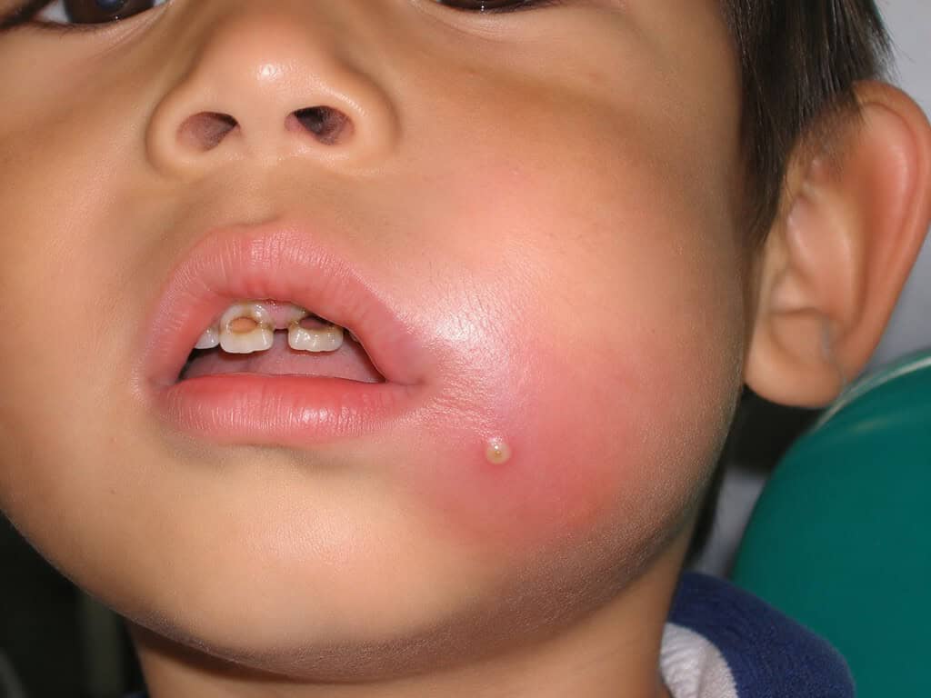 Pulpite estiva nei bambini 4 Bambino che soffre di pulpite