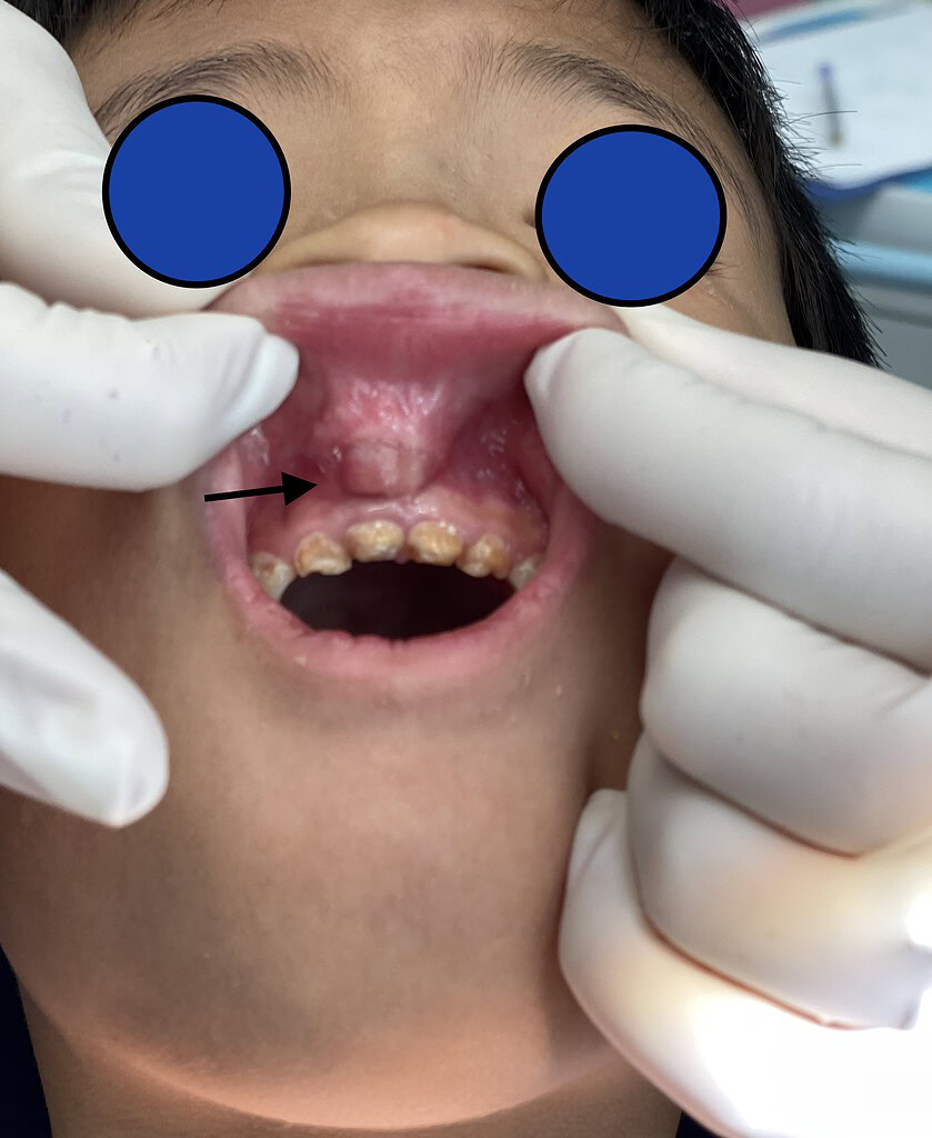 Pulpite estiva nei bambini 3 Diagnosi pulpite bambino
